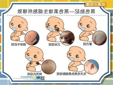 腳踝胎記