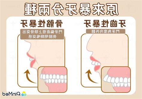暴牙面相