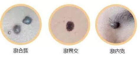 突出來的痣