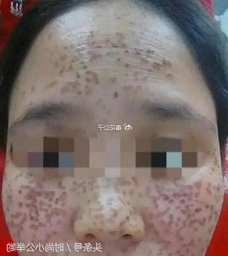 臉部長斑