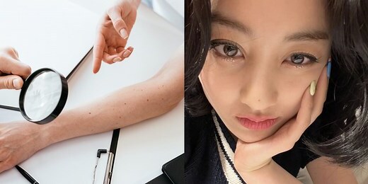手肘長痣