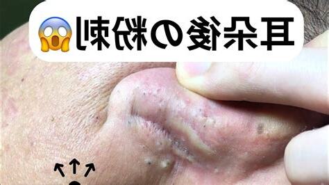 耳珠長痘痘