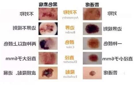 痣是如何形成的