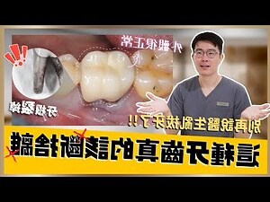 拔下來的牙齒怎麼處理